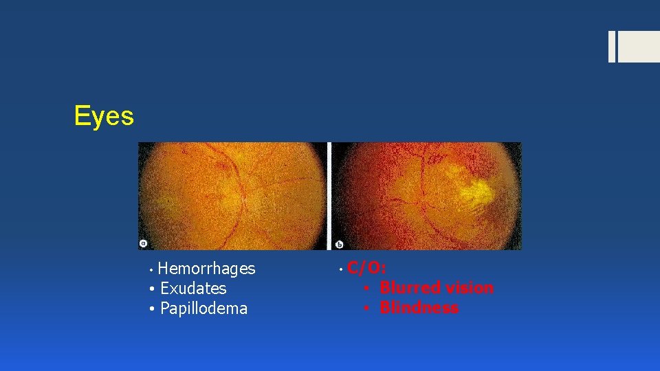 Eyes Hemorrhages • Exudates • Papillodema • • C/O: • Blurred vision • Blindness