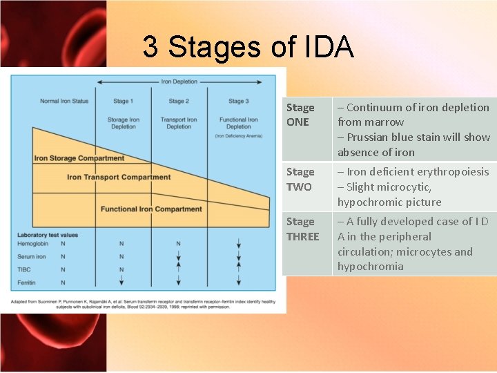 3 Stages of IDA Stage ONE – Continuum of iron depletion from marrow –