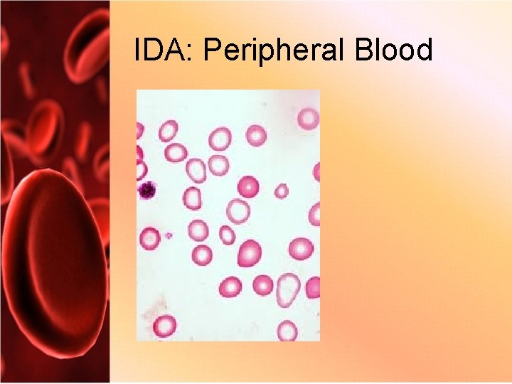 IDA: Peripheral Blood 