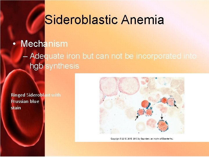 Sideroblastic Anemia • Mechanism – Adequate iron but can not be incorporated into hgb