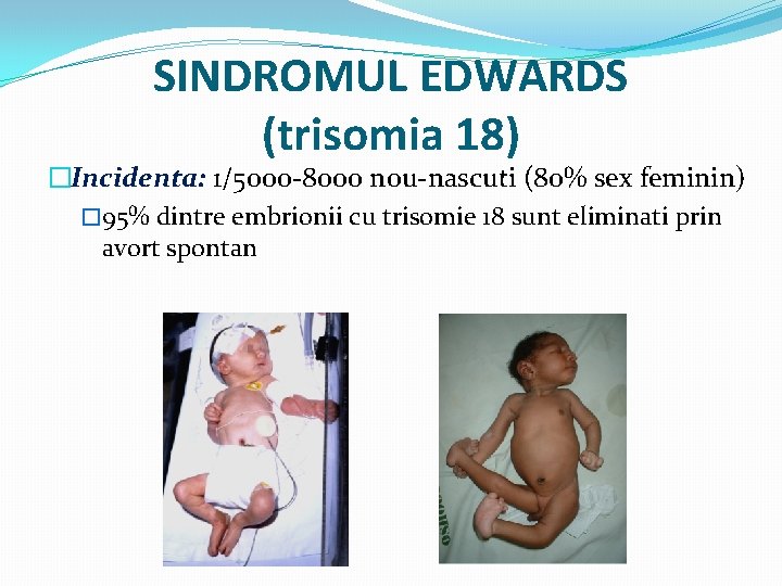 SINDROMUL EDWARDS (trisomia 18) �Incidenta: 1/5000 -8000 nou-nascuti (80% sex feminin) � 95% dintre