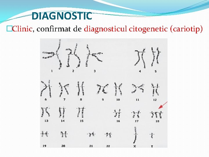 DIAGNOSTIC �Clinic, confirmat de diagnosticul citogenetic (cariotip) 
