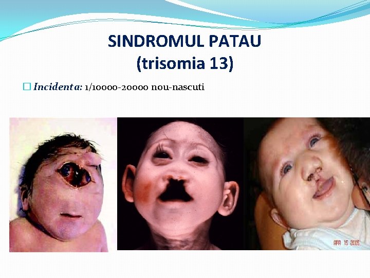 SINDROMUL PATAU (trisomia 13) � Incidenta: 1/10000 -20000 nou-nascuti 