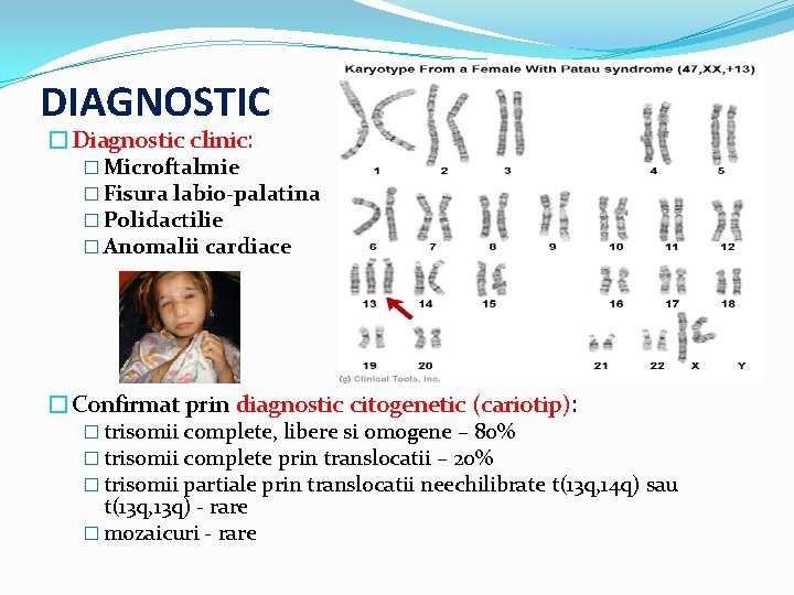 DIAGNOSTIC �Diagnostic clinic: � Microftalmie � Fisura labio-palatina � Polidactilie � Anomalii cardiace �Confirmat