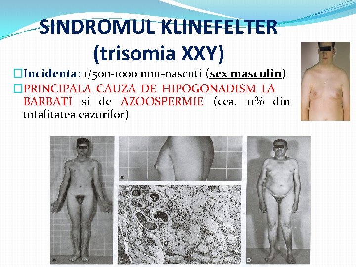 SINDROMUL KLINEFELTER (trisomia XXY) �Incidenta: 1/500 -1000 nou-nascuti (sex masculin) �PRINCIPALA CAUZA DE HIPOGONADISM