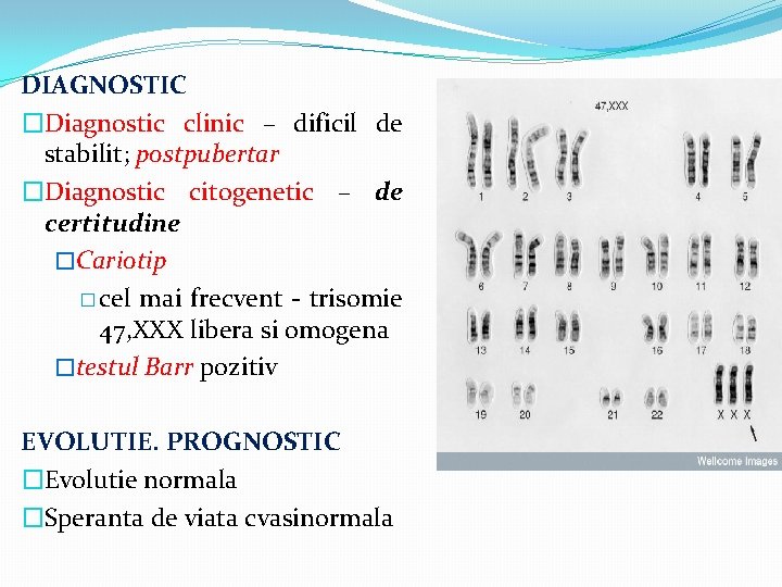 DIAGNOSTIC �Diagnostic clinic – dificil de stabilit; postpubertar �Diagnostic citogenetic – de certitudine �Cariotip