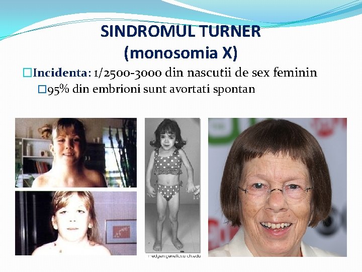 SINDROMUL TURNER (monosomia X) �Incidenta: 1/2500 -3000 din nascutii de sex feminin � 95%