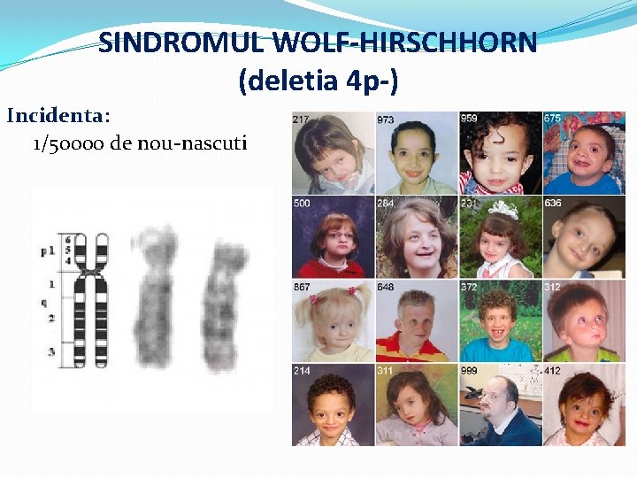 SINDROMUL WOLF-HIRSCHHORN (deletia 4 p-) Incidenta: 1/50000 de nou-nascuti 