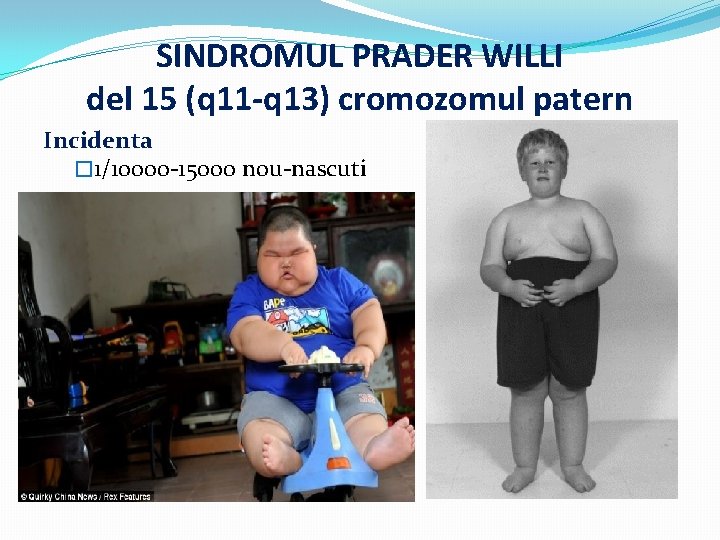 SINDROMUL PRADER WILLI del 15 (q 11 -q 13) cromozomul patern Incidenta � 1/10000
