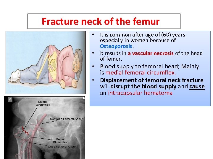 Fracture neck of the femur • It is common after age of (60) years