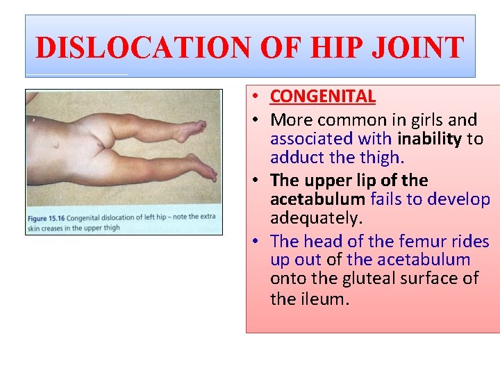 DISLOCATION OF HIP JOINT • CONGENITAL • More common in girls and associated with