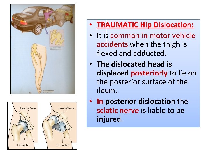  • TRAUMATIC Hip Dislocation: • It is common in motor vehicle accidents when