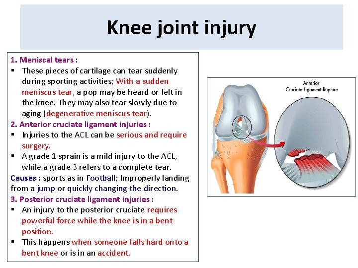 Knee joint injury 1. Meniscal tears : § These pieces of cartilage can tear Knee joint injury 1. Meniscal tears : § These pieces of cartilage can tear