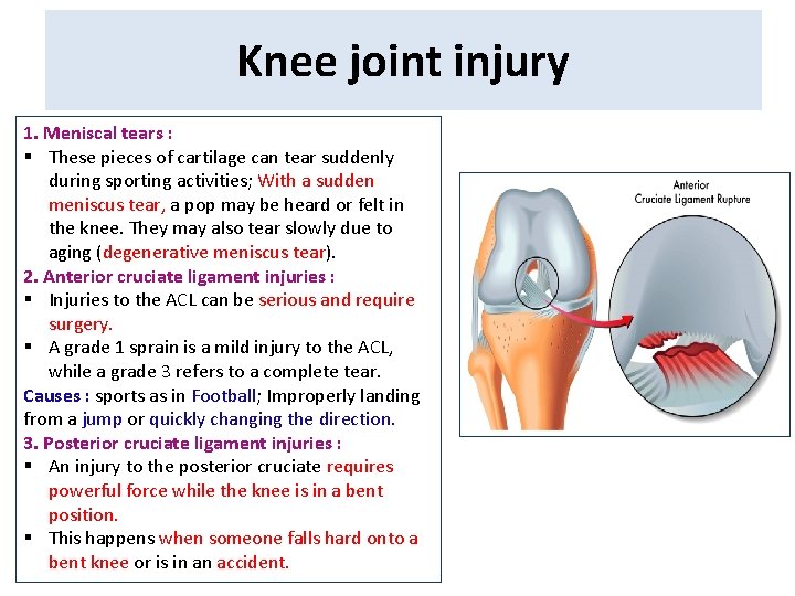 Knee joint injury 1. Meniscal tears : § These pieces of cartilage can tear