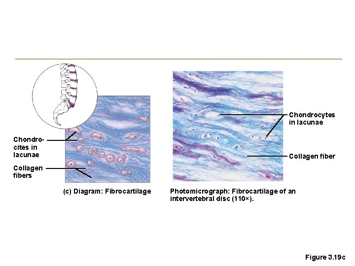 Chondrocytes in lacunae Chondrocites in lacunae Collagen fibers (c) Diagram: Fibrocartilage Photomicrograph: Fibrocartilage of