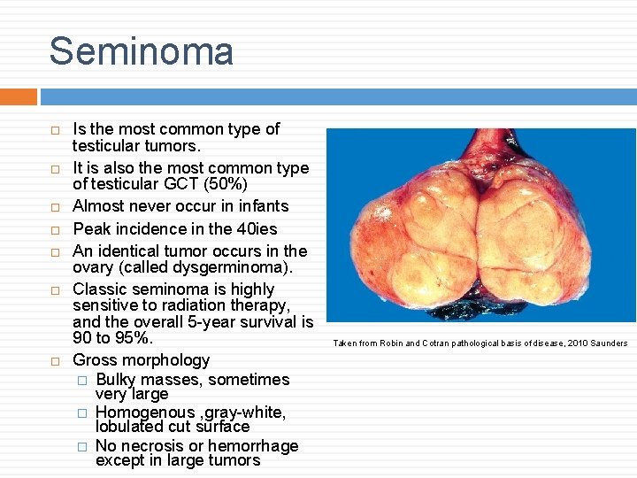 Seminoma Is the most common type of testicular tumors. It is also the most