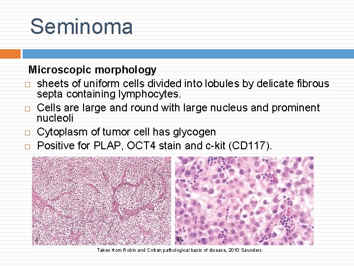 Seminoma Microscopic morphology sheets of uniform cells divided into lobules by delicate fibrous septa Seminoma Microscopic morphology sheets of uniform cells divided into lobules by delicate fibrous septa