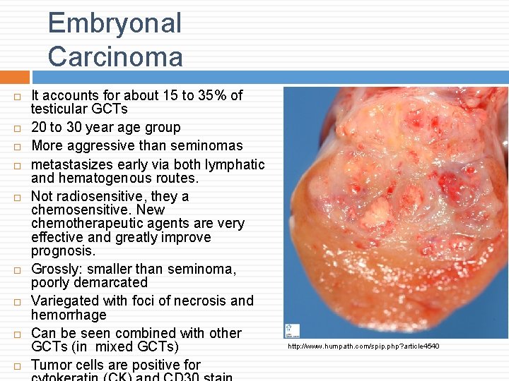 Embryonal Carcinoma It accounts for about 15 to 35% of testicular GCTs 20 to Embryonal Carcinoma It accounts for about 15 to 35% of testicular GCTs 20 to