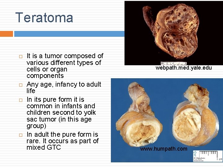 Teratoma It is a tumor composed of various different types of cells or organ Teratoma It is a tumor composed of various different types of cells or organ