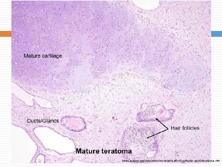 www. auanet. org/education/modules/pathology/testis-germ/teratoma. cfm www. auanet. org/education/modules/pathology/testis-germ/teratoma. cfm