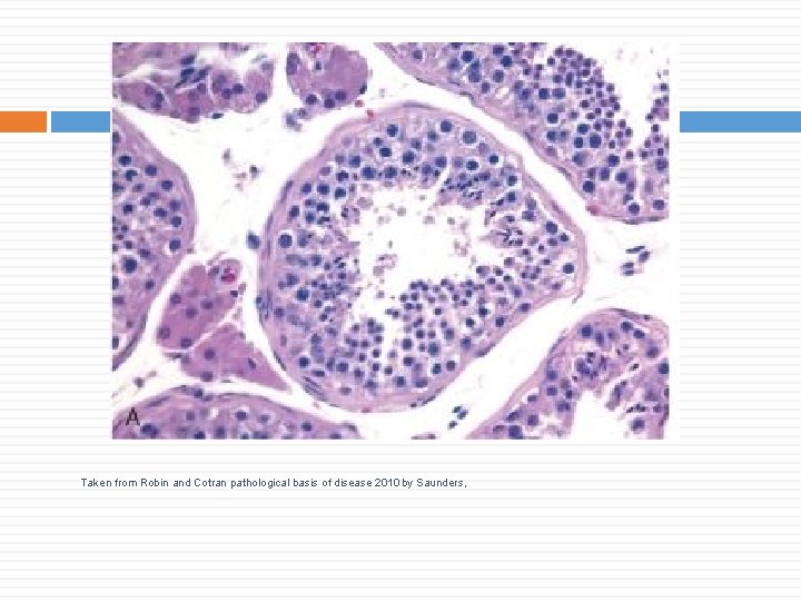 Taken from Robin and Cotran pathological basis of disease 2010 by Saunders, 