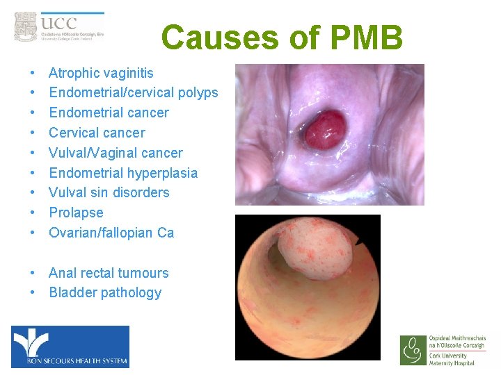 Causes of PMB • • • Atrophic vaginitis Endometrial/cervical polyps Endometrial cancer Cervical cancer