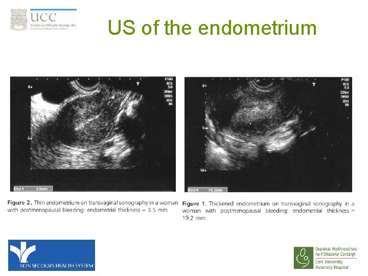 US of the endometrium 