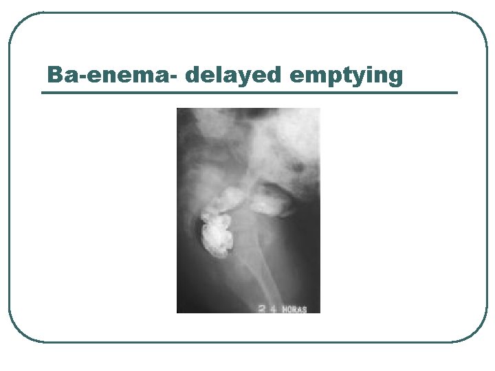 Ba-enema- delayed emptying 