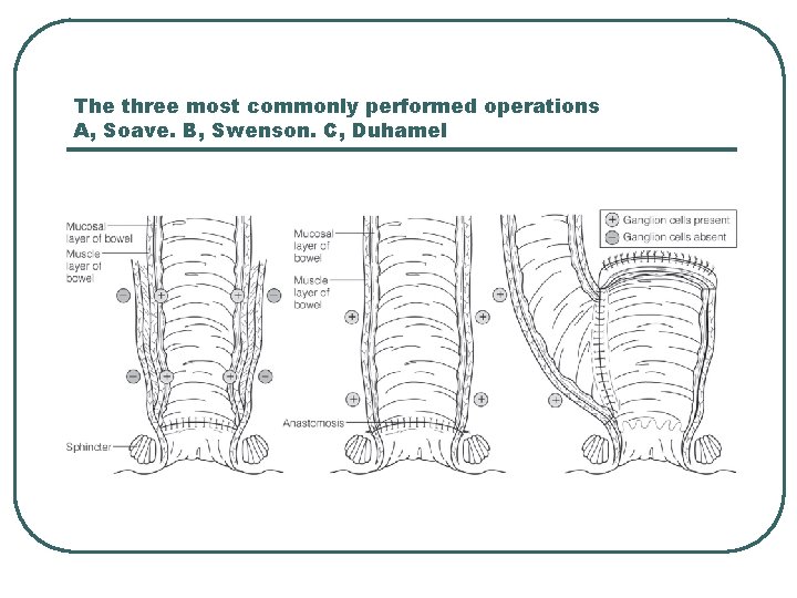 The three most commonly performed operations A, Soave. B, Swenson. C, Duhamel 