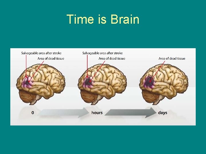 Time is Brain 