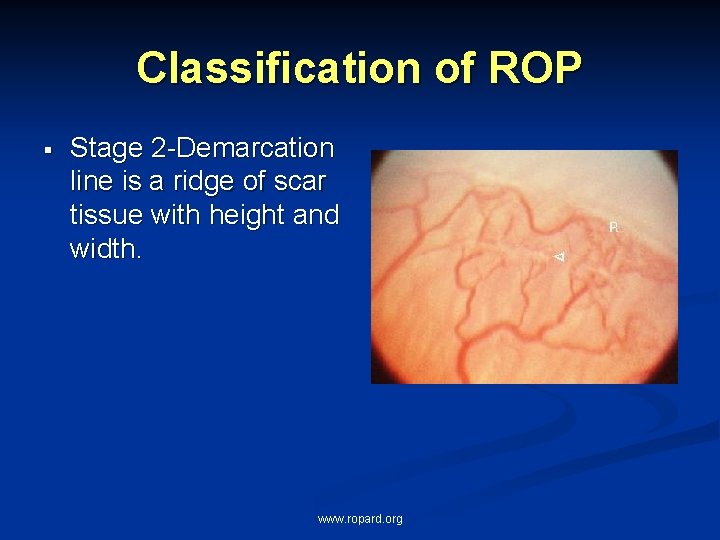 Classification of ROP § Stage 2 -Demarcation line is a ridge of scar tissue