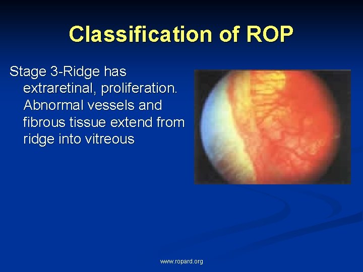 Classification of ROP Stage 3 -Ridge has extraretinal, proliferation. Abnormal vessels and fibrous tissue