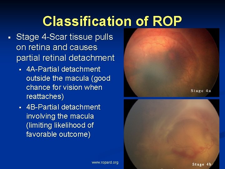 Classification of ROP § Stage 4 -Scar tissue pulls on retina and causes partial