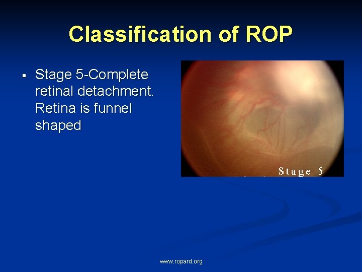 Classification of ROP § Stage 5 -Complete retinal detachment. Retina is funnel shaped www.