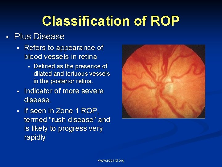 Classification of ROP § Plus Disease § Refers to appearance of blood vessels in