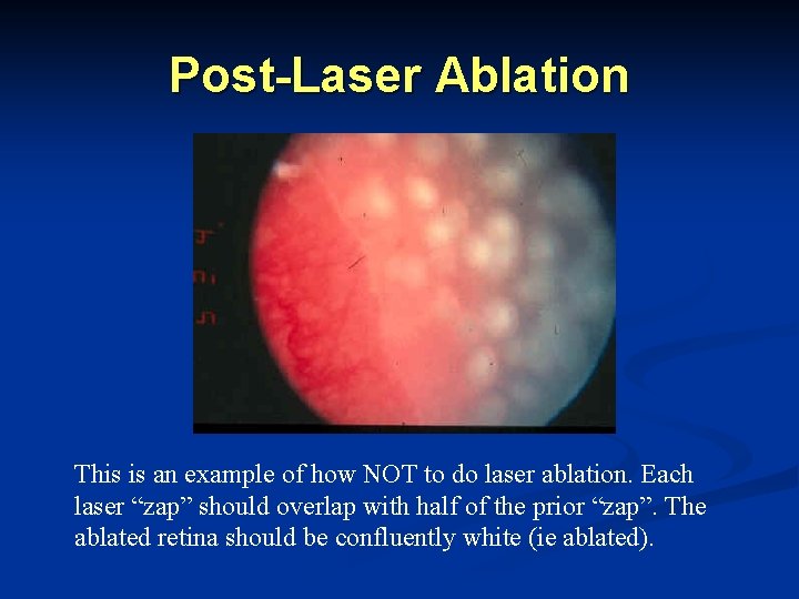 Post-Laser Ablation This is an example of how NOT to do laser ablation. Each