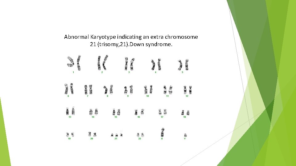 Abnormal Karyotype indicating an extra chromosome 21 (trisomy, 21). Down syndrome. 