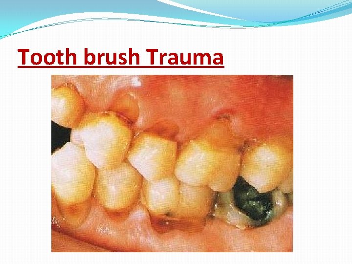 Tooth brush Trauma 