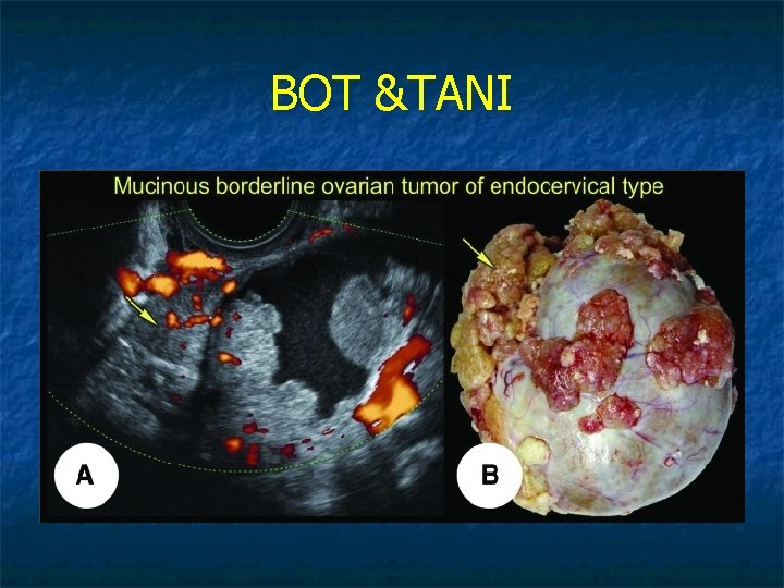 BOT &TANI 