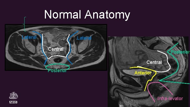 Normal Anatomy Lateral Central Posterior Anterior Infra-levator 