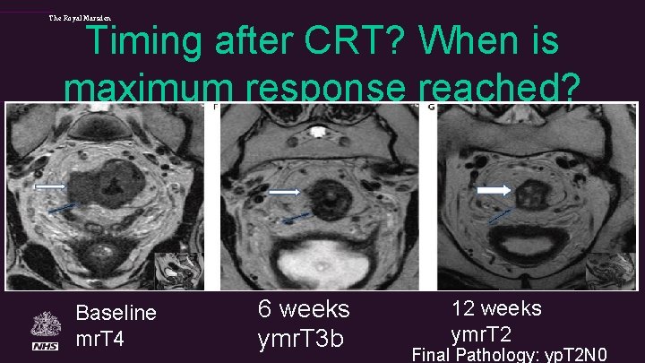 The Royal Marsden Timing after CRT? When is maximum response reached? Baseline mr. T
