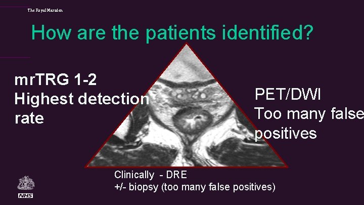 The Royal Marsden How are the patients identified? mr. TRG 1 -2 Highest detection