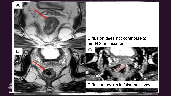 The Royal Marsden Diffusion does not contribute to mr. TRG assessment Diffusion results in