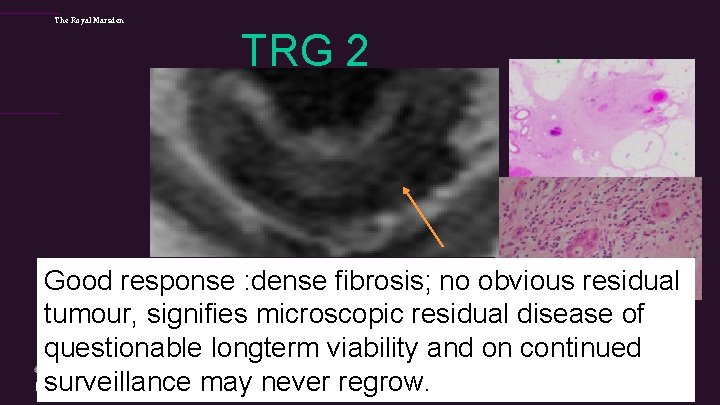 The Royal Marsden TRG 2 Good response : dense fibrosis; no obvious residual tumour,