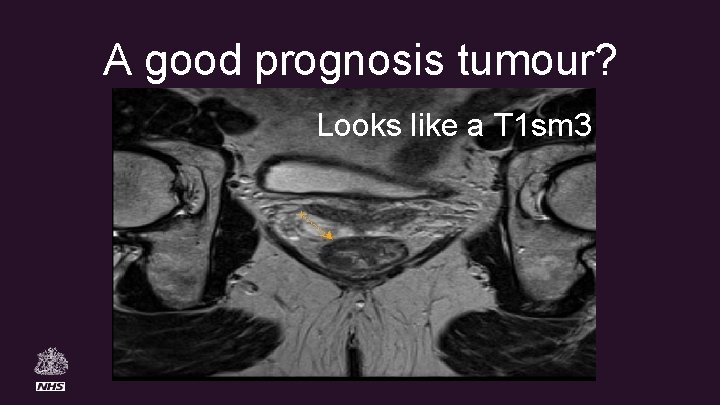 A good prognosis tumour? Looks like a T 1 sm 3 