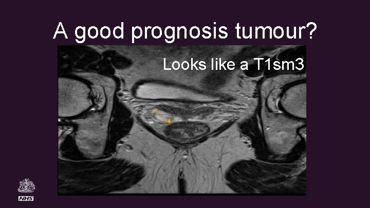 A good prognosis tumour? Looks like a T 1 sm 3 