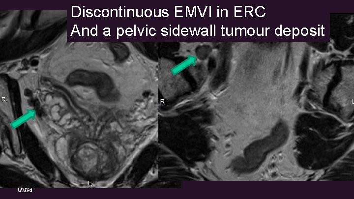 Discontinuous EMVI in ERC And a pelvic sidewall tumour deposit 