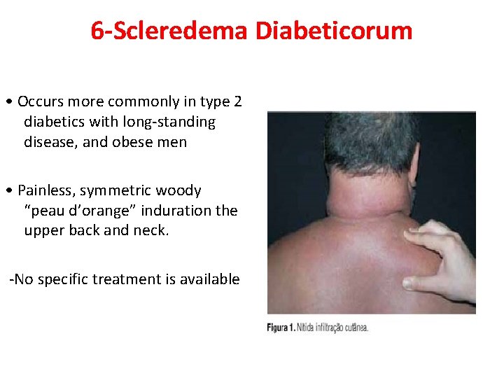 6 -Scleredema Diabeticorum • Occurs more commonly in type 2 diabetics with long-standing disease,