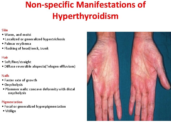Non-specific Manifestations of Hyperthyroidism Skin • Warm, and moist • Localized or generalized hypertrichosis