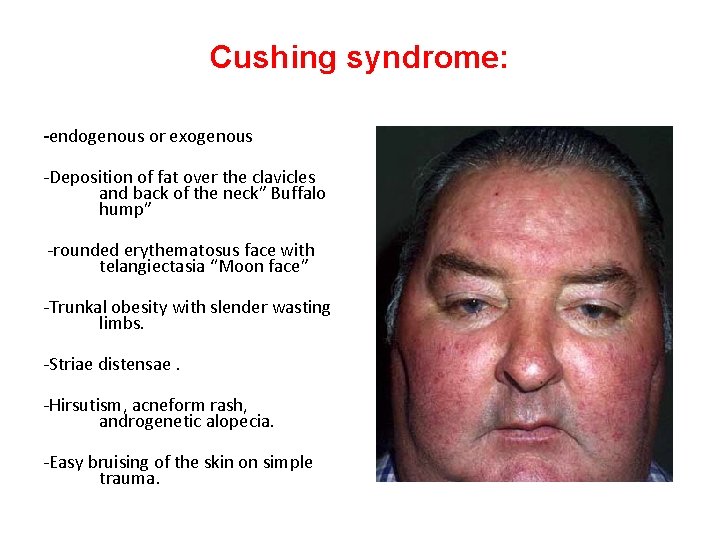 Cushing syndrome: -endogenous or exogenous -Deposition of fat over the clavicles and back of